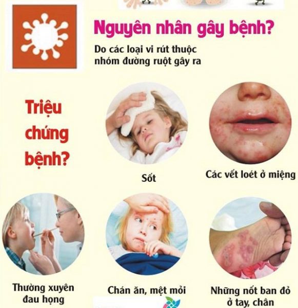 Dấu hiệu bệnh tay chân miệng ở trẻ