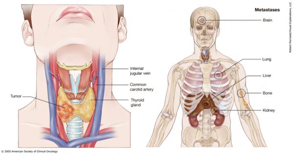 Dấu hiệu bệnh ung thư tuyến giáp giai đoạn cuối