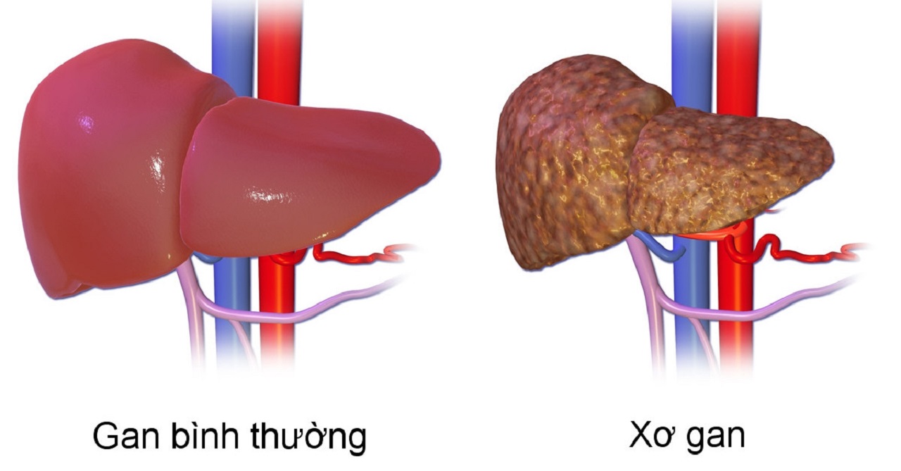 Dấu hiệu bệnh xơ gan và cách phòng tránh hiệu quả