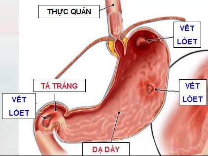 Dấu hiệu bị bệnh về tiêu hóa