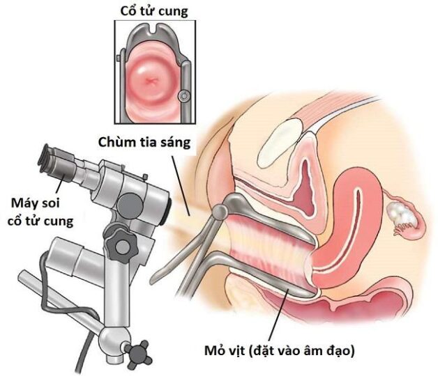 Dấu hiệu cần đi khám sàng lọc ung thư cổ tử cung