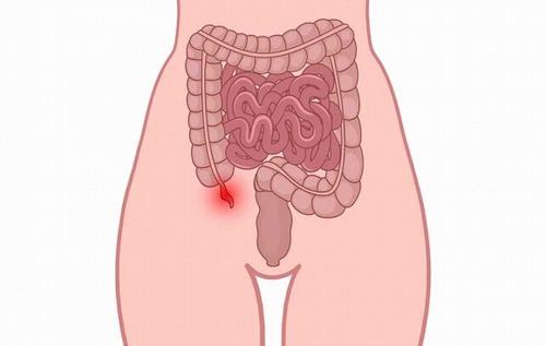 Dấu hiệu cảnh báo vỡ ruột thừa