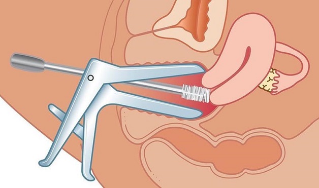 Dấu hiệu của bệnh ung thư cổ tử cung cần lưu ý