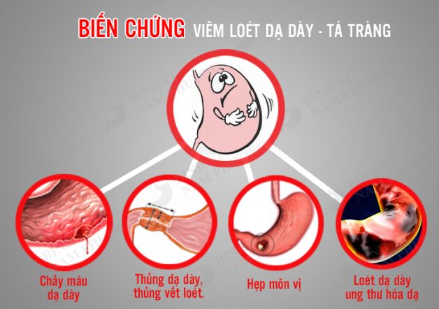 Dấu hiệu của loét dạ dày: cảnh báo biến chứng nguy hiểm