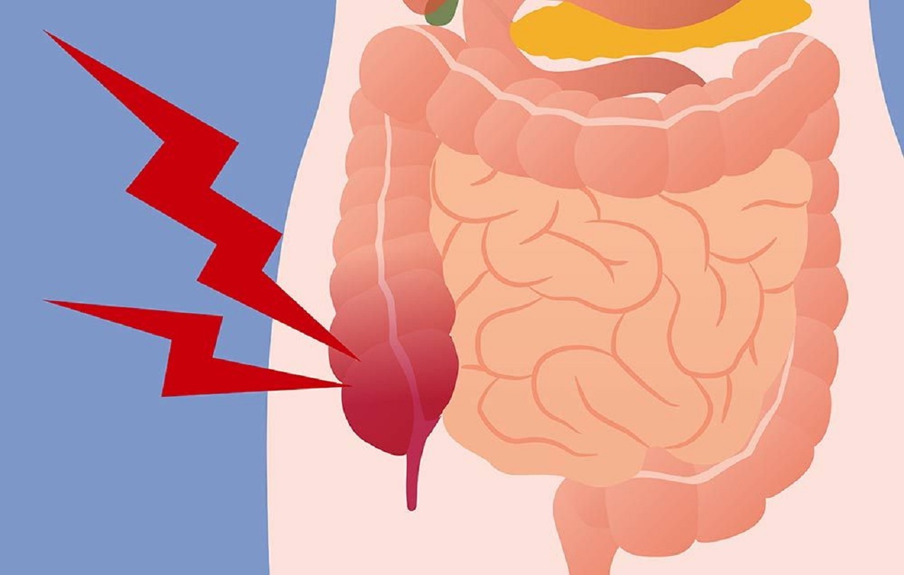 Dấu hiệu của ruột thừa và các thông tin cần biết