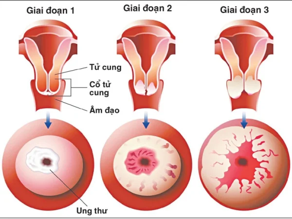 Dấu hiệu của ung thư cổ tử cung giai đoạn đầu