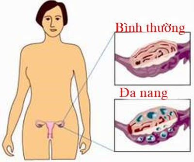 Dấu hiệu đa nang buồng trứng sự mất cân bằng nội tiết tố