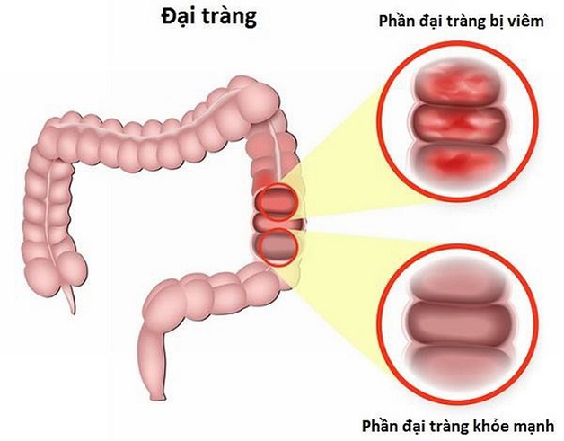 Dấu hiệu đại tràng có vấn đề, nguyên nhân, điều trị