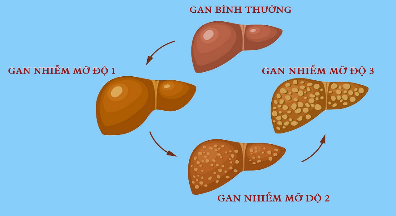 Dấu hiệu gan nhiễm mỡ nhẹ và phương pháp điều trị