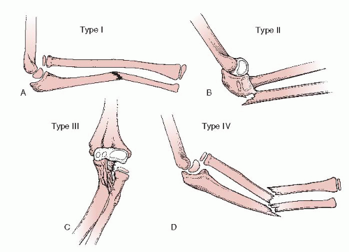 Dấu hiệu gãy xương khuỷu tay và cách điều trị