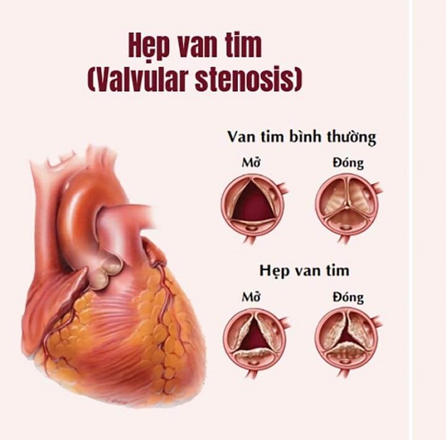 Dấu hiệu hẹp van tim theo nguyên nhân và mức độ bệnh 