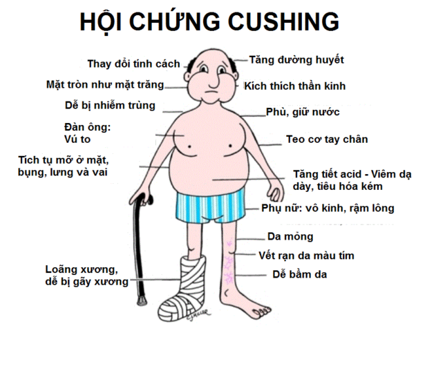 Dấu hiệu khối u tuyến yên cần lưu ý