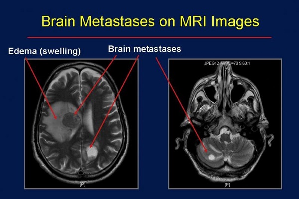 Dấu hiệu nhận biết ung thư vú di căn não