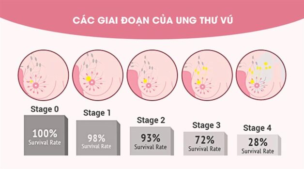 Dấu hiệu nhận biết ung thư vú giai đoạn đầu