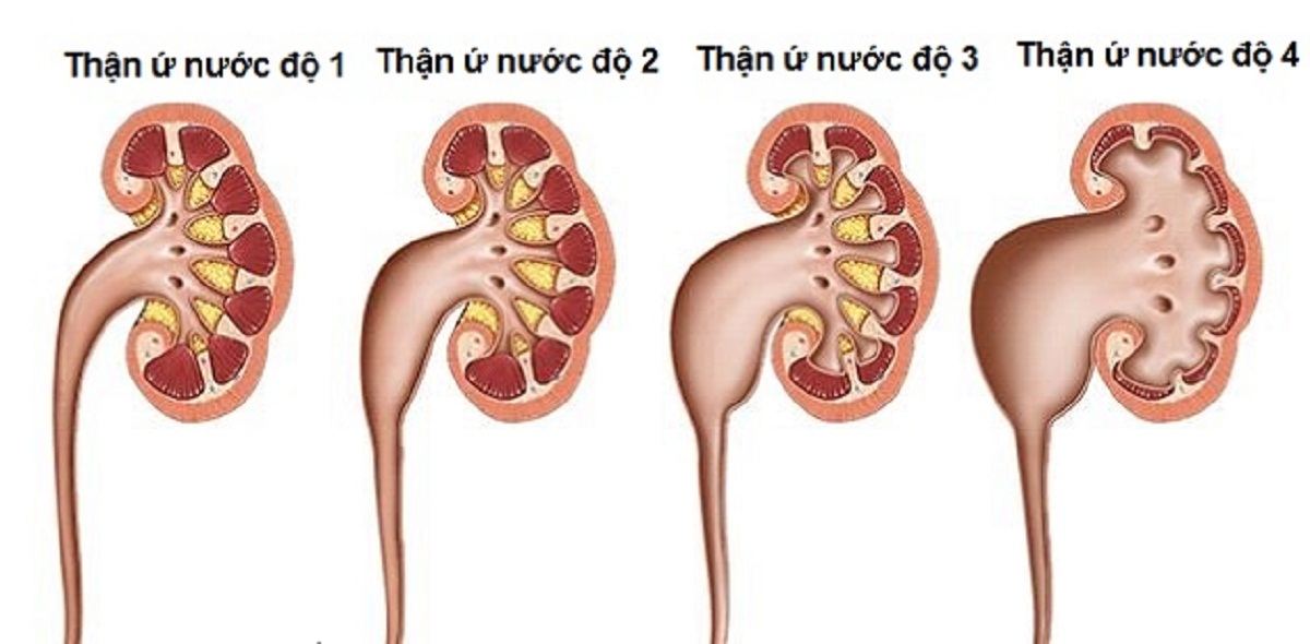 Dấu hiệu nhận biết và phương pháp điều trị sỏi thận ứ nước