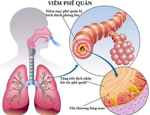 Dấu hiệu nhận biết viêm phế quản cấp