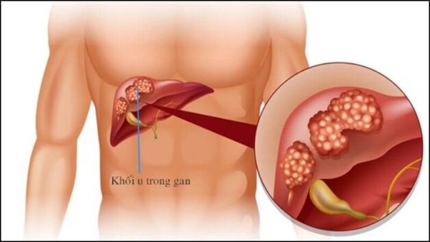 Dấu hiệu nhận diện 5 loại ung thư gan phổ biến