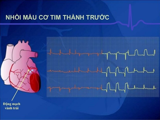 Dấu hiệu nhồi máu cơ tim trên ECG là gì?