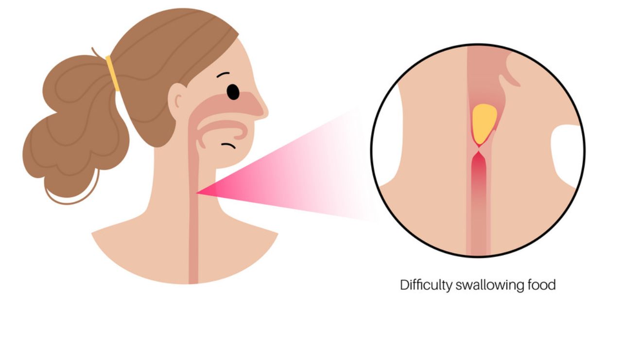 Dấu hiệu nuốt nghẹn thực quản và phương pháp chẩn đoán