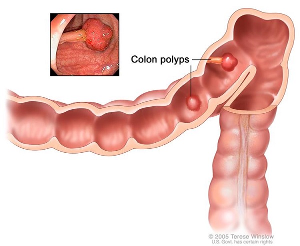 Dấu hiệu polyp đại tràng