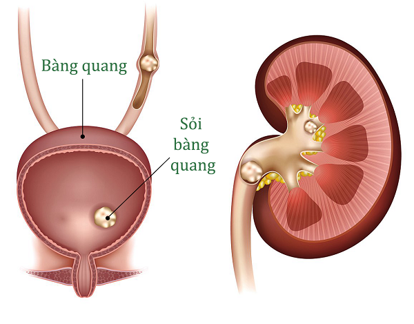 Dấu hiệu sỏi bàng quang là gì?