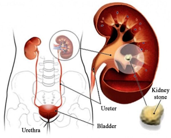 Dấu hiệu sỏi tiết niệu và các phương pháp điều trị sỏi