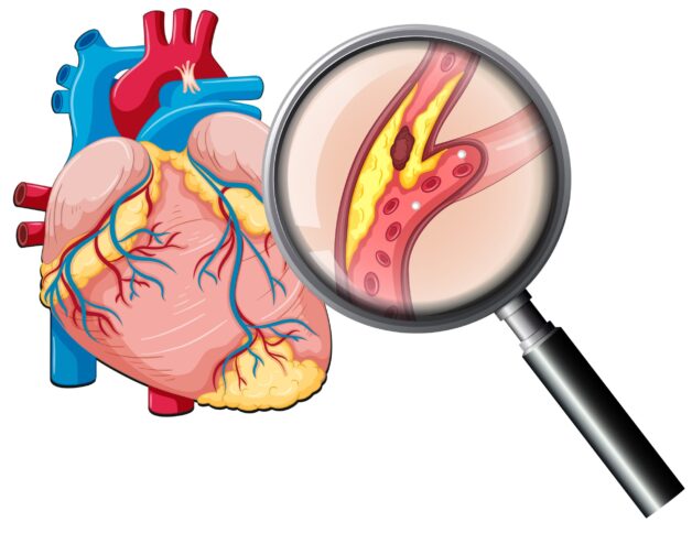 Dấu hiệu thiếu máu cơ tim cần lưu ý