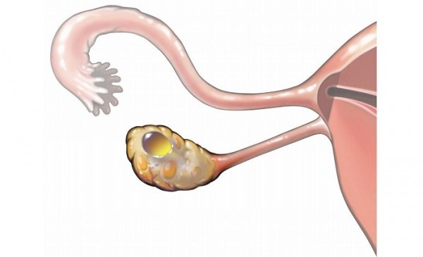 Dấu hiệu u nang buồng trứng chị em cần chú ý