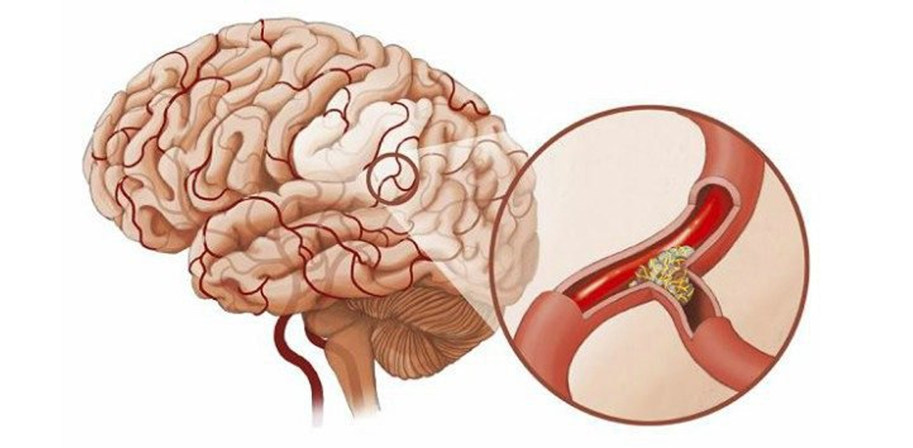 Dấu hiệu u tuyến yên: Cách nhận biết