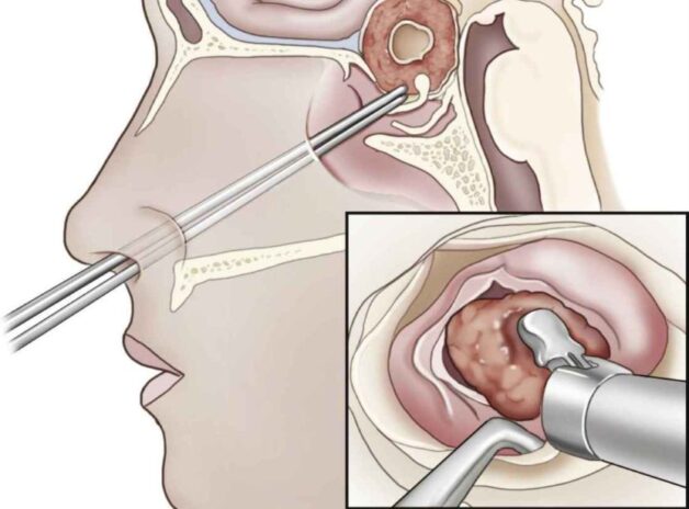 Dấu hiệu u tuyến yên: Cách nhận biết