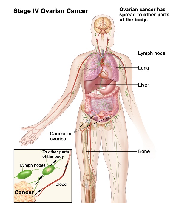 Dấu hiệu ung thư buồng trứng di căn