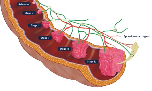 Dấu hiệu ung thư đại tràng giai đoạn 3 và cách điều trị