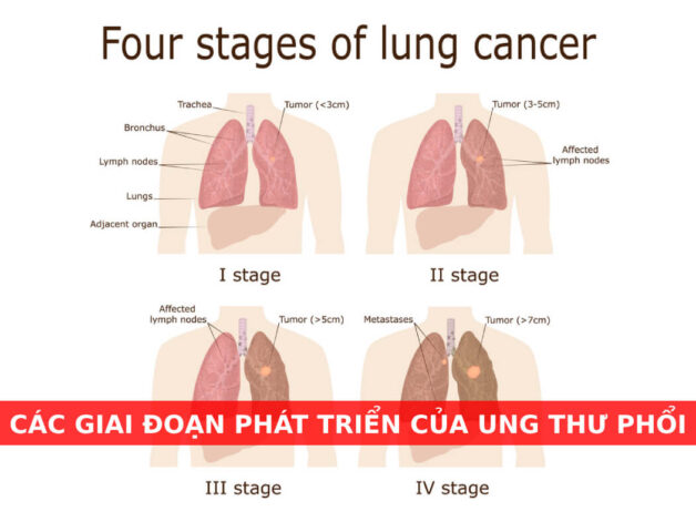 Dấu hiệu ung thư phổi giai đoạn 2 phổ biến cần biết