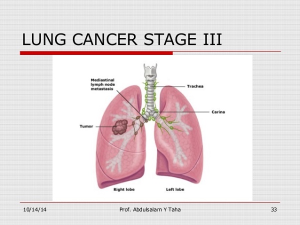 Dấu hiệu ung thư phổi giai đoạn 3