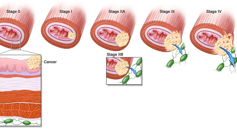 Dấu hiệu ung thư thực quản giai đoạn 3