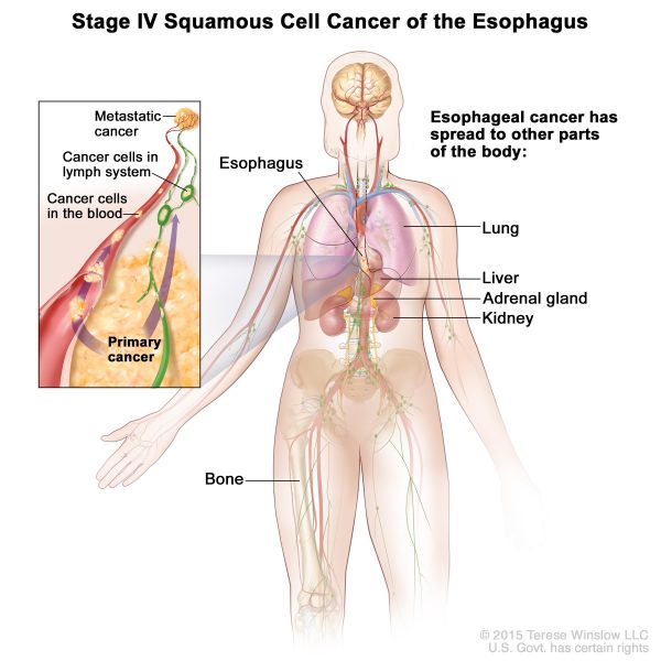 Dấu hiệu ung thư thực quản giai đoạn 4