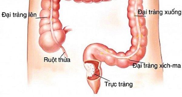 Dấu hiệu ung thư trực tràng giai đoạn III