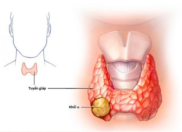 Dấu hiệu ung thư tuyến giáp bạn không thể bỏ qua