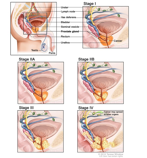 Dấu hiệu ung thư tuyến tiền liệt giai đoạn II