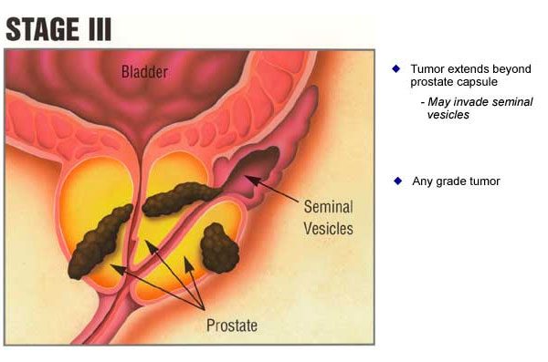 Dấu hiệu ung thư tuyến tiền liệt giai đoạn III