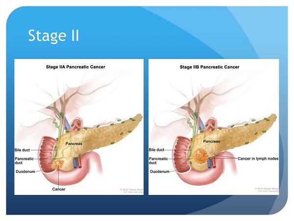 Dấu hiệu ung thư tuyến tụy giai đoạn II