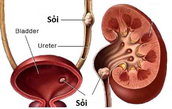 Dấu hiệu và biến chứng khi sỏi thận xuống niệu quản