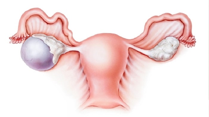 Dấu hiệu và cách điều trị bệnh u nang buồng trứng trái