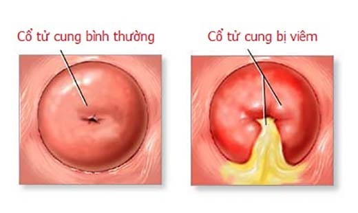 Dấu hiệu viêm lộ tuyến cổ tử cung, bạn đã biết?