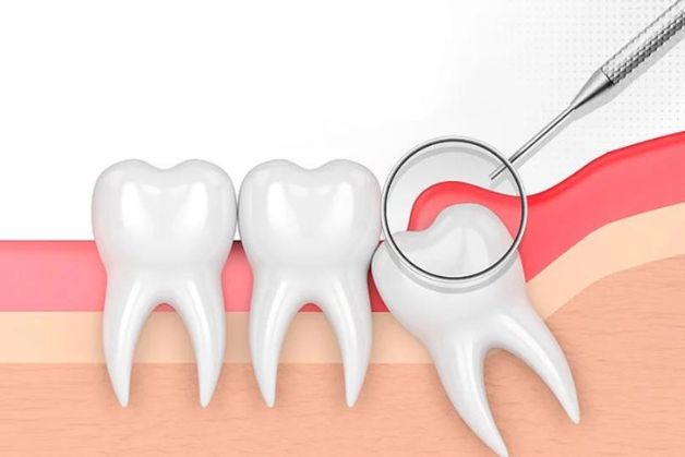 Dấu hiệu viêm lợi trùm chân răng không thể bỏ qua