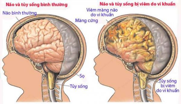 Dấu hiệu viêm màng não ở trẻ em nhận biết sớm để xử trí