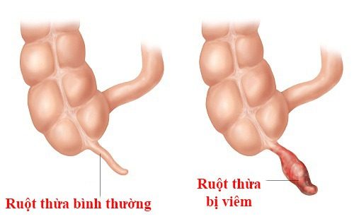 Dấu hiệu viêm ruột thừa bạn cần biết