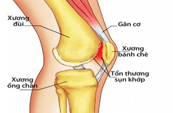 Đau khớp gối – nguyên nhân và cách khắc phục