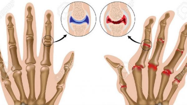 Đau khớp ngón tay là dấu hiệu của bệnh gì?