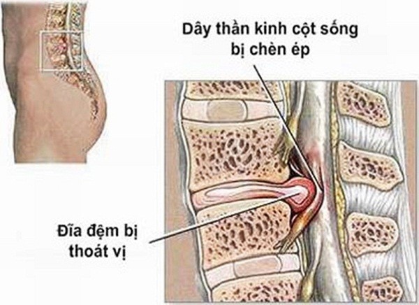 Ðau lưng do hẹp ống sống thắt lưng có nguy hiểm?